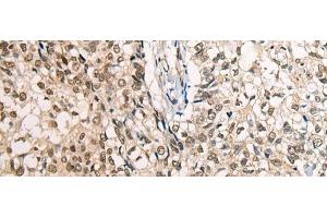 Immunohistochemistry of paraffin-embedded Human lung cancer tissue using CDT1 Polyclonal Antibody at dilution of 1:45(x200) (CDT1 抗体)