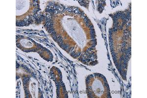 Immunohistochemistry of Human colon cancer using PCDHAC2 Polyclonal Antibody at dilution of 1:50 (PCDHAC2 抗体)