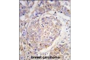 Forlin-fixed and paraffin-embedded hun breast carcino tissue reacted with GEA10 antibody (C-term) (ABIN390102 and ABIN2840614) , which was peroxidase-conjugated to the secondary antibody, followed by DAB staining. (MAGEA10 抗体  (C-Term))