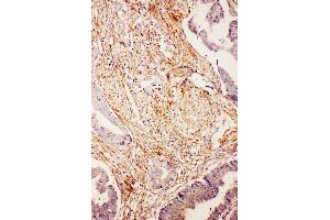 Anti-Diubiquitin antibody, IHC(P) IHC(P): Human Intestinal Cancer Tissue (UBD 抗体  (N-Term))