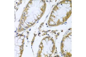 Immunohistochemistry of paraffin-embedded human colon carcinoma using FBXL5 antibody at dilution of 1:100 (x40 lens). (FBXL5 抗体)