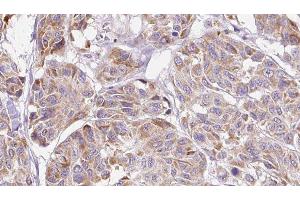 ABIN6276808 at 1/100 staining Human Melanoma tissue by IHC-P. (CCL4 抗体  (Internal Region))