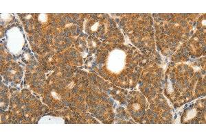Immunohistochemistry of paraffin-embedded Human thyroid cancer using PRDX3 Polyclonal Antibody at dilution of 1:50 (Peroxiredoxin 3 抗体)