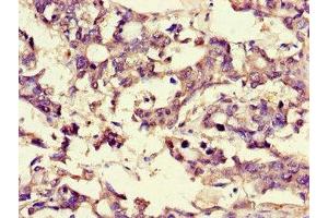 Immunohistochemistry of paraffin-embedded human gastric cancer using ABIN7159937 at dilution of 1:100 (BRP44 抗体  (AA 1-40))