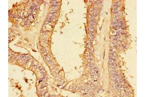 Immunohistochemistry of paraffin-embedded human endometrial cancer using ABIN7149414 at dilution of 1:100 (PLA2G4A 抗体  (AA 379-533))