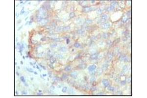 Immunohistochemical analysis of paraffin-embedded human cervical carcinoma, showing cytoplasmic localization with DAB staining using KARS mouse mAb. (KARS 抗体)