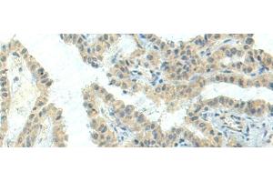 Immunohistochemistry of paraffin-embedded Human thyroid cancer tissue using NPVF Polyclonal Antibody at dilution of 1:80(x200) (NPVF 抗体)