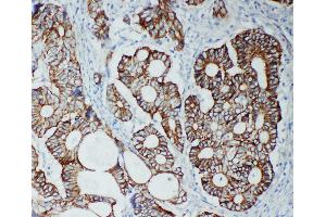 Anti-TJP2 antibody, IHC(P) IHC(P): Human Intestinal Cancer Tissue