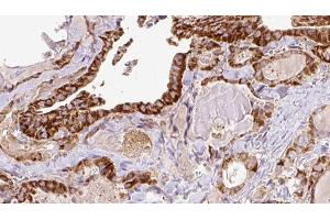 ABIN6267196 at 1/100 staining Human thyroid cancer tissue by IHC-P. (TPT1 抗体  (pSer46))