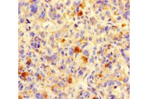 Immunohistochemistry of paraffin-embedded human melanoma using ABIN7161076 at dilution of 1:100 (B7-H6 抗体  (AA 25-262))