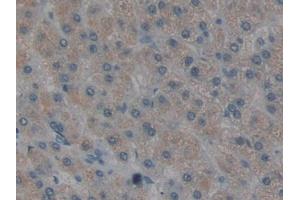 DAB staining on IHC-P; Samples: Human Liver cancer Tissue (MOK 抗体  (AA 173-418))