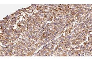 ABIN6279301 at 1/100 staining Human Melanoma tissue by IHC-P. (CMTM7 抗体  (Internal Region))