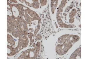 IHC-P Image Immunohistochemical analysis of paraffin-embedded N87 xenograft, using TXNRD1, antibody at 1:100 dilution.