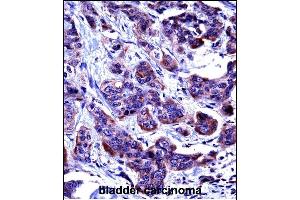 CASP6 Antibody (N-term) ((ABIN657756 and ABIN2846738))immunohistochemistry analysis in formalin fixed and paraffin embedded human bladder carcinoma followed by peroxidase conjugation of the secondary antibody and DAB staining. (Caspase 6 抗体  (N-Term))