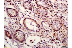 Formalin-fixed and paraffin embedded human colon carcinoma labeled with Anti-phospho-PI 3 Kinase p110 delta (Tyr524) Polyclonal Antibody, Unconjugated (ABIN711776) at 1:200 followed by conjugation to the secondary antibody and DAB staining