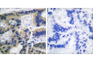 Cl-peptide - +Immunohistochemical analysis of paraffin-embedded human lung carcinoma tissue using Caspase 7 (cleaved-Asp198) antibody. (Caspase 7 抗体  (Cleaved-Asp198))