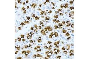 Immunohistochemical analysis of ASMTL staining in human gastric cancer formalin fixed paraffin embedded tissue section. (ASMTL 抗体)