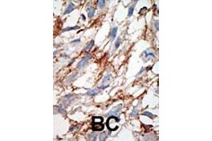 Formalin-fixed and paraffin-embedded human cancer tissue reacted with the primary antibody, which was peroxidase-conjugated to the secondary antibody, followed by DAB staining. (ISG15 抗体  (N-Term))