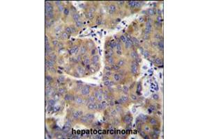 EIF3H Antibody immunohistochemistry analysis in formalin fixed and paraffin embedded human hepatocarcinoma followed by peroxidase conjugation of the secondary antibody and DAB staining.
