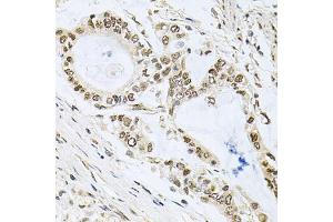 Immunohistochemistry of paraffin-embedded human gastric cancer using MCL1 antibody (ABIN5970080) at dilution of 1/100 (40x lens). (MCL-1 抗体  (C-Term))