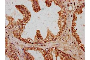 IHC image of ABIN7166723 diluted at 1:400 and staining in paraffin-embedded human prostate cancer performed on a Leica BondTM system. (HYI 抗体  (AA 1-174))