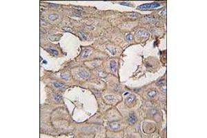 Formalin-fixed and paraffin-embedded human lung carcinoma tissue reacted with ANXA2 antibody (N-term), which was peroxidase-conjugated to the secondary antibody, followed by DAB staining. (Annexin A2 抗体  (N-Term))