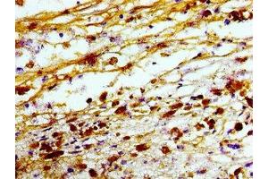 Immunohistochemistry of paraffin-embedded human melanoma using ABIN7173382 at dilution of 1:100 (TREM2 抗体  (AA 19-174))