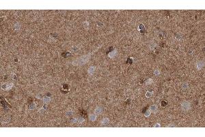 ABIN6277707 at 1/100 staining Human brain cancer tissue by IHC-P. (SH3G2 抗体  (Internal Region))