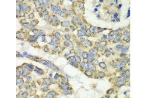 Immunohistochemistry of paraffin-embedded Human esophageal cancer using TUFM Polyclonal Antibody at dilution of 1:100 (40x lens). (TUFM 抗体)