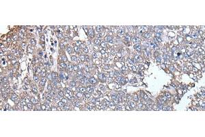 Immunohistochemistry of paraffin-embedded Human liver cancer tissue using SCP2 Polyclonal Antibody at dilution of 1:35(x200) (SCP2 抗体)