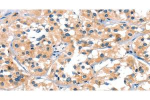 Immunohistochemistry of paraffin-embedded Human thyroid cancer tissue using SLC6A4 Polyclonal Antibody at dilution of 1:30 (SLC6A4 抗体)