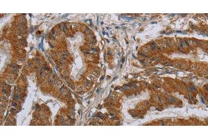 Immunohistochemistry of paraffin-embedded Human esophagus cancer using CSH1 Polyclonal Antibody at dilution of 1:40 (CSH1 抗体)