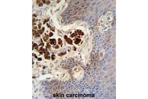 COL19A1 antibody (N-term) immunohistochemistry analysis in formalin fixed and paraffin embedded human skin carcinoma followed by peroxidase conjugation of the secondary antibody and DAB staining. (COL19A1 抗体  (Chain alpha 1, N-Term))