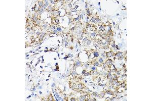 Immunohistochemistry of paraffin-embedded human breast cancer using R Rabbit pAb (ABIN3017320, ABIN3017321, ABIN3017322 and ABIN6220039) at dilution of 1:200 (40x lens). (RAMP2 抗体  (AA 1-145))