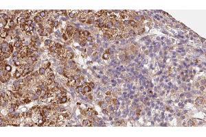 ABIN6279677 at 1/100 staining Human liver cancer tissue by IHC-P. (KCNG4 抗体  (Internal Region))