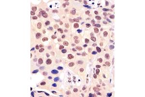 (ABIN6242199 and ABIN6577161) staining BANP in human breast carcinoma tissue sections by Immunohistochemistry (IHC-P - paraformaldehyde-fixed, paraffin-embedded sections). (BANP 抗体  (AA 30-390))