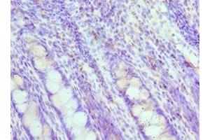 Immunohistochemistry of paraffin-embedded human colon cancer using ABIN7160088 at dilution of 1:100