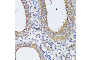 Immunohistochemistry of paraffin-embedded human uterine cancer using ERK1 / ERK2 antibody (ABIN7268619) at dilution of 1:200 (40x lens).