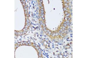 Immunohistochemistry of paraffin-embedded human uterine cancer using ERK1 / ERK2 antibody (ABIN7268619) at dilution of 1:200 (40x lens). (ERK1 抗体  (AA 200-300))