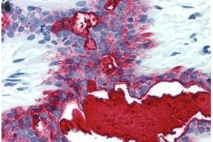 Human Breast (formalin-fixed, paraffin-embedded) stained with MUC1 antibody ABIN396912 at 5 ug/ml followed by biotinylated anti-mouse IgG secondary antibody ABIN481714, alkaline phosphatase-streptavidin and chromogen. (MUC1 抗体)