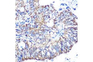 Immunohistochemistry of paraffin-embedded human colon carcinoma using IDH2 Rabbit mAb (ABIN7268028) at dilution of 1:100 (40x lens). (IDH2 抗体)