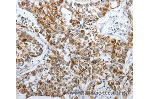 Immunohistochemistry of Human lung cancer using PDK2 Polyclonal Antibody at dilution of 1:40 (PDK2 抗体)
