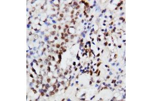 Anti-ERK1 antibody, IHC(P) IHC(P): Human Mammary Cancer Tissue