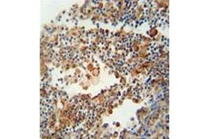 Immunohistochemistry analysis in formalin fixed and paraffin embedded human lung carcinoma reacted with OR9Q1 Antibody (C-term) Cat.