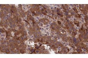 ABIN6277375 at 1/100 staining Human liver cancer tissue by IHC-P. (GLRA1 抗体  (Internal Region))