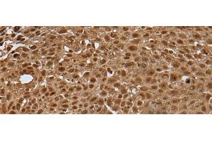 Immunohistochemistry of paraffin-embedded Human lung cancer tissue using LAMTOR5 Polyclonal Antibody at dilution of 1:35(x200) (HBXIP 抗体)