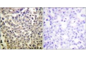 Immunohistochemistry analysis of paraffin-embedded human breast carcinoma, using PAK1/2/3 (Phospho-Thr423/402/421) Antibody. (PAK1/2/3 抗体  (pThr423))
