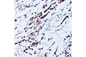 Immunohistochemistry of paraffin-embedded human breast cancer using SPN antibody (ABIN5973813) at dilution of 1/100 (40x lens). (CD43 抗体)