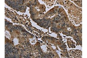 The image on the left is immunohistochemistry of paraffin-embedded Human colon cancer tissue using ABIN7129664(GSTO1 Antibody) at dilution 1/60, on the right is treated with fusion protein. (GSTO1 抗体)
