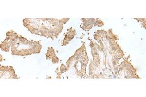 Immunohistochemistry of paraffin-embedded Human thyroid cancer tissue using HDHD2 Polyclonal Antibody at dilution of 1:40(x200) (HDHD2 抗体)